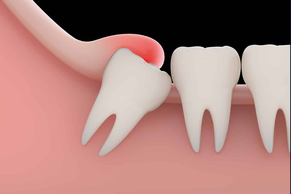 Extraire les dents de sagesse, est-ce nécessaire ?