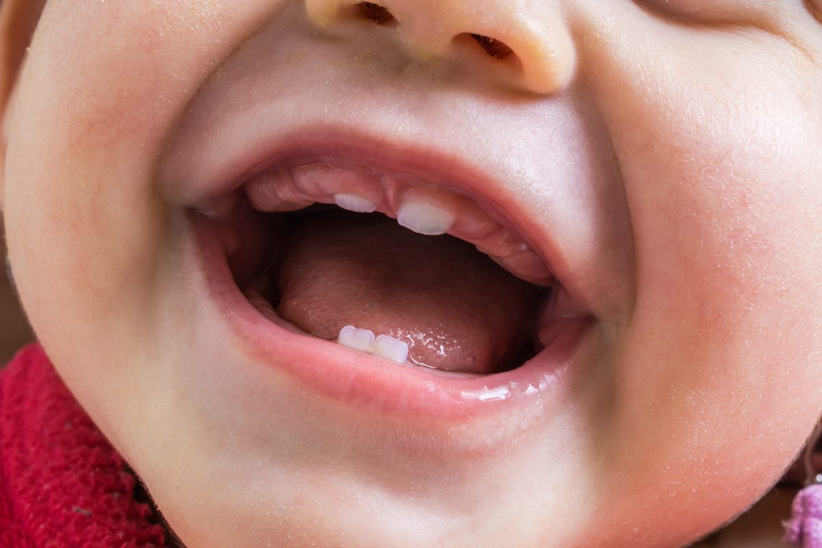 Doublement des gencives et poussée dentaire : nos conseils