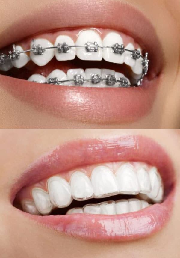 Qu’est-ce qu’un traitement d’orthodontie ?