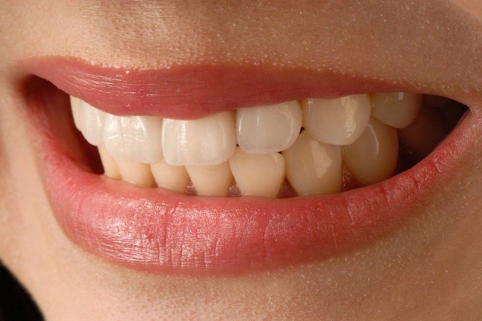 Correction d’une supraclusion avec un appareil dentaire lingual : avantages et inconvénients